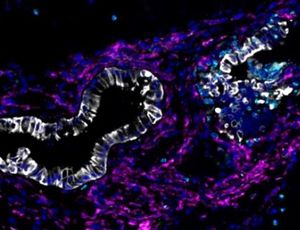 Bauchspeicheldrüsenkrebs-Zellen im Fokus (Bild: T. Santos, DKTK, TUM)