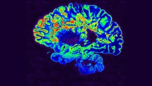 Gehirn eines MS-Kranken: Befallene Zellen scheinen in roter Farbe auf (Foto: hopkinsmedicine.org)